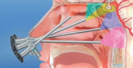 Abord endoscopique endonasale de la base du crâne.