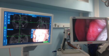 Endoscopie endonasale: Ecran haute définition face au chirurgien. Le système de neuronavigation est à gauche.