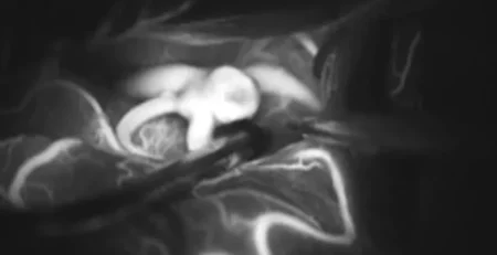Vidéo-angiographie peropératoire. Image intraopératoire d’anévrysme au microscope en angiographie par fluorescence.