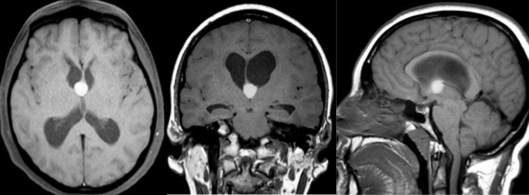 Kyste colloïde Neurochirurgie Lariboisière