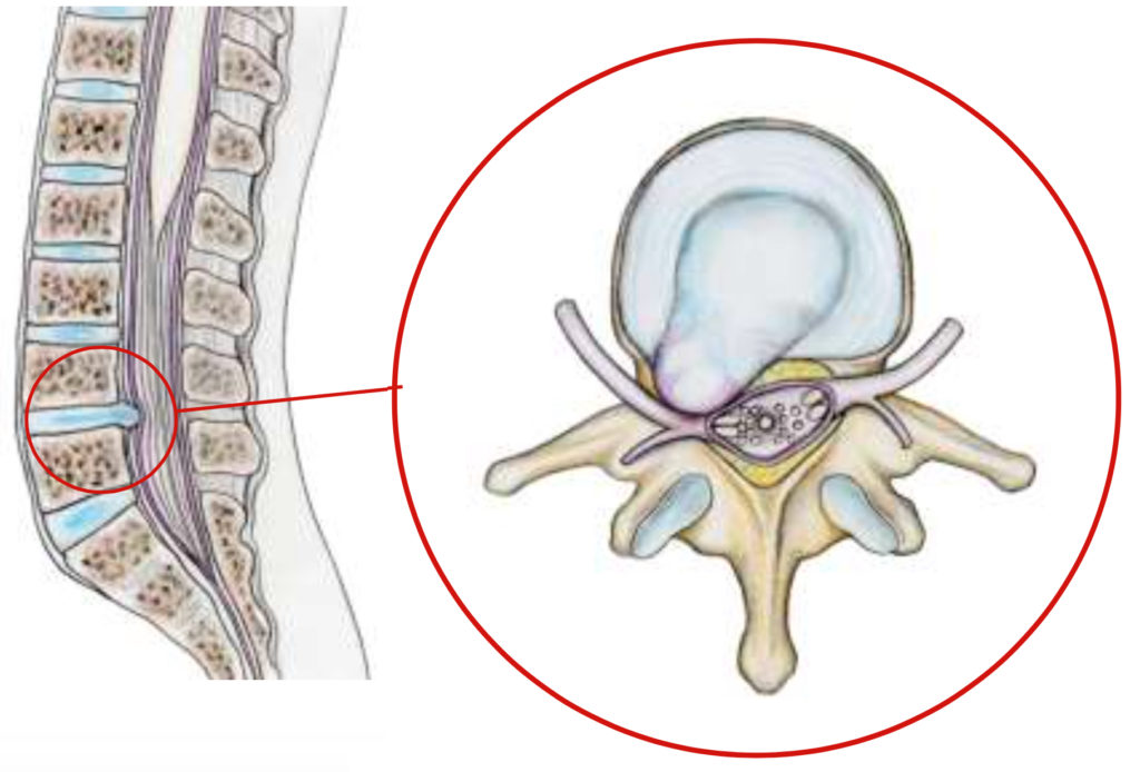 Hernie discale Neurochirurgie Lariboisière