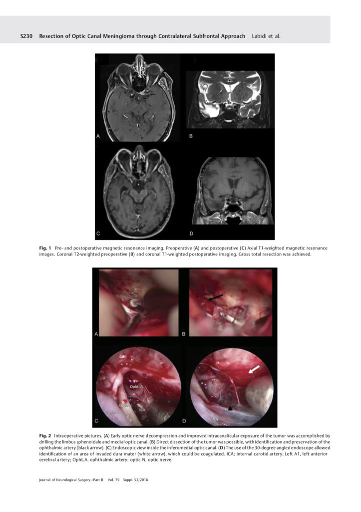 Méningiome du tubercule sellaire Service de Neurochirurgie Lariboisière